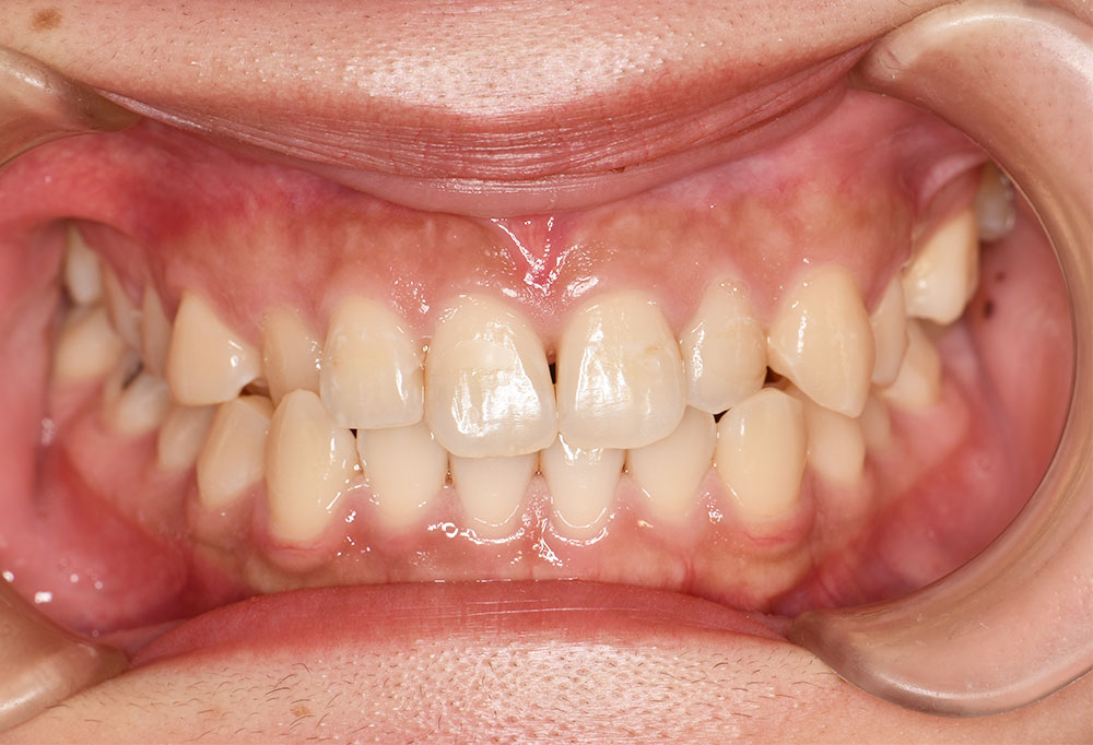 治療前_Q4ワイヤー矯正