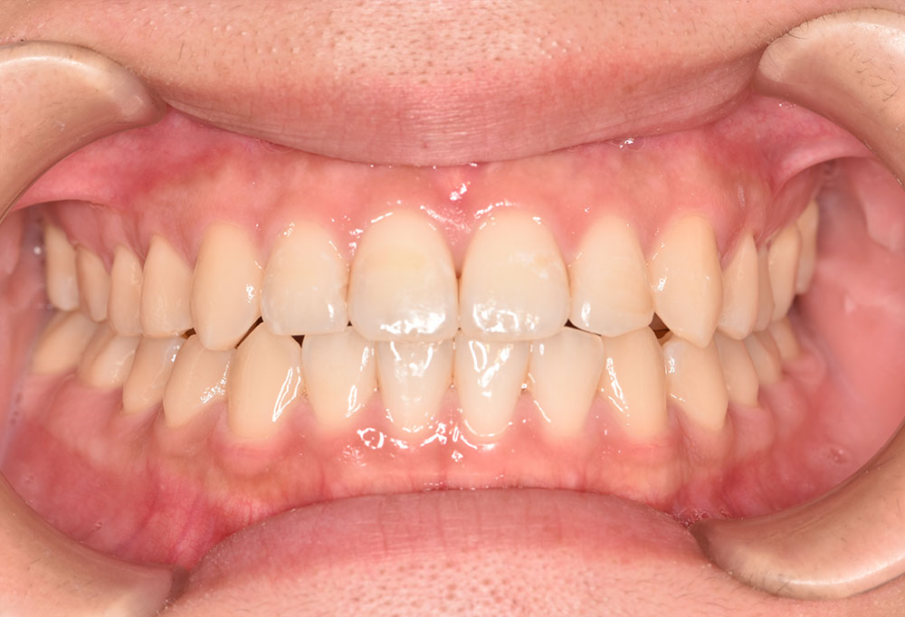 治療後_ワイヤー矯正Q4