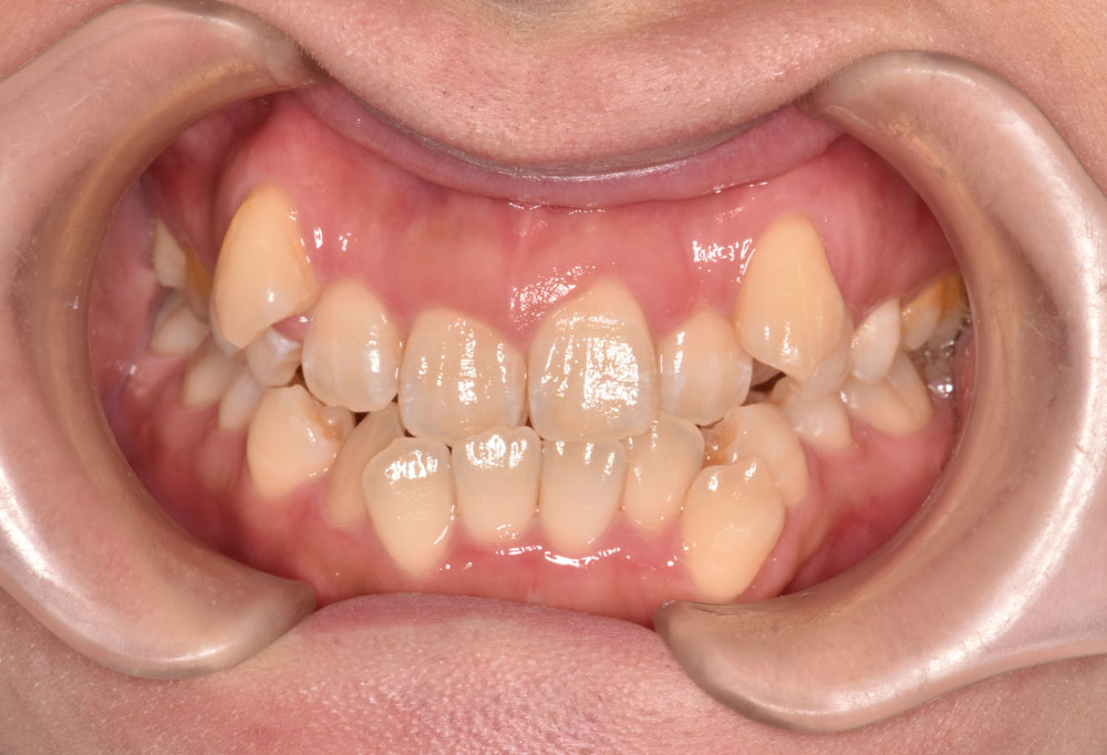 治療前_Q4ワイヤー矯正