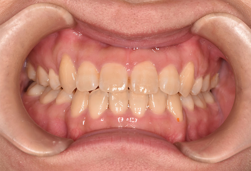 治療後_ワイヤー矯正Q4